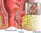 anorectal fistula